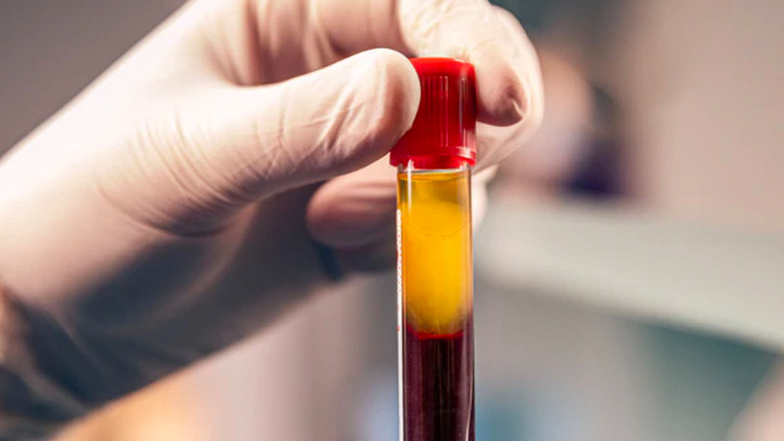 A gloved hand holding a test tube of centrifuged blood, with yellow plasma separated above the red cells.