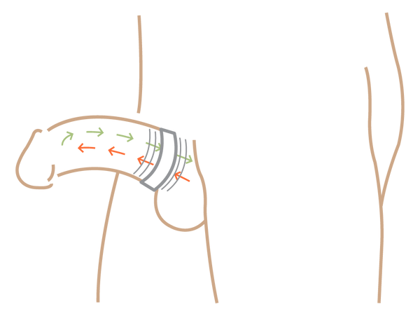 A conventional ring sliding during sex